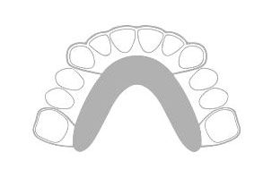 Herausnehmbare Zahnspange - Kieferorthopädie Wiesloch Dr. Prein