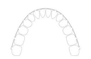 Festsitzende Zahnspange - Kieferorthopädie Wiesloch Dr. Prein