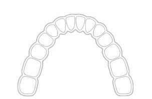 Schienen / Aligner / Invisalign - Kieferorthopädie Wiesloch Dr. Prein