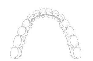 Festsitzende Zahnspange innen - Kieferorthopädie Wiesloch Dr. Prein